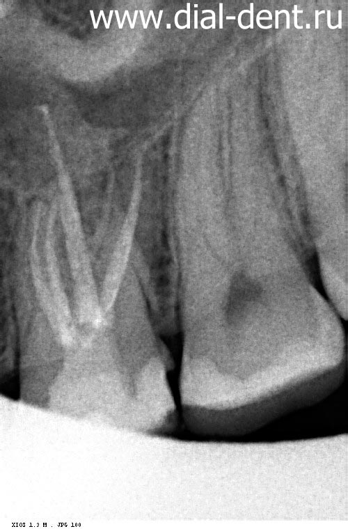 каналы зуба запломбированы после лечения