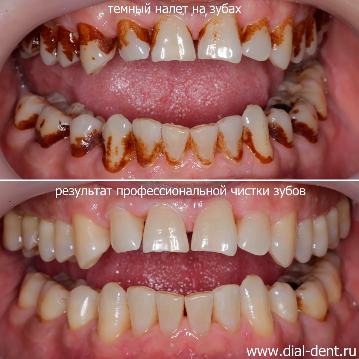 до и после профессиональной чистки зубов
