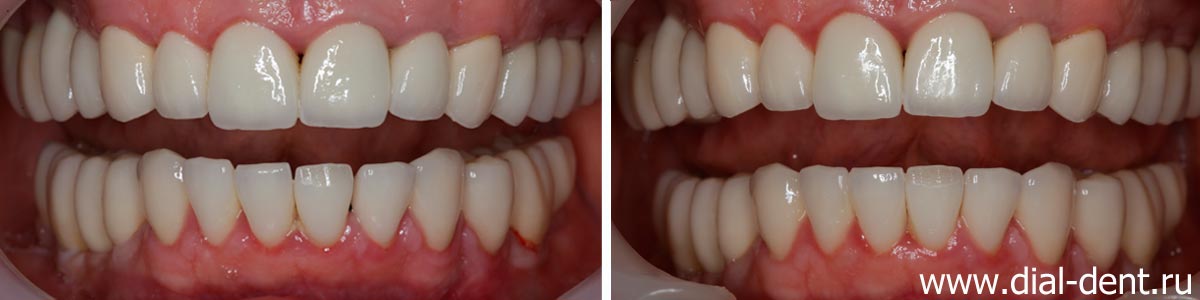 до и после лечения капами для выравнивания зубов