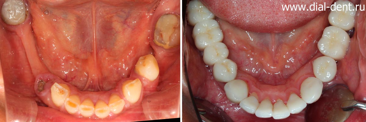 до и после протезирования зубов керамическими коронками