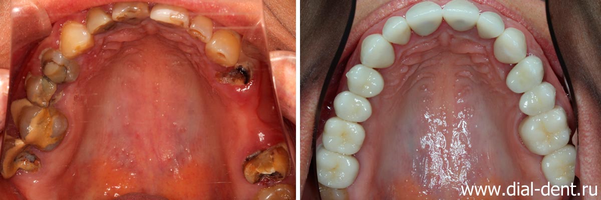 до и после протезирования зубов керамическими коронками