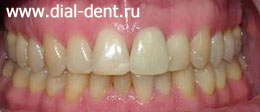 дефекты зубов - откол зуба