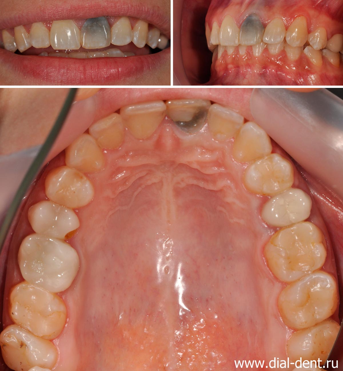 зуб потемнел после удаления нерва и лечения депофорезом гидроокиси меди-кальция