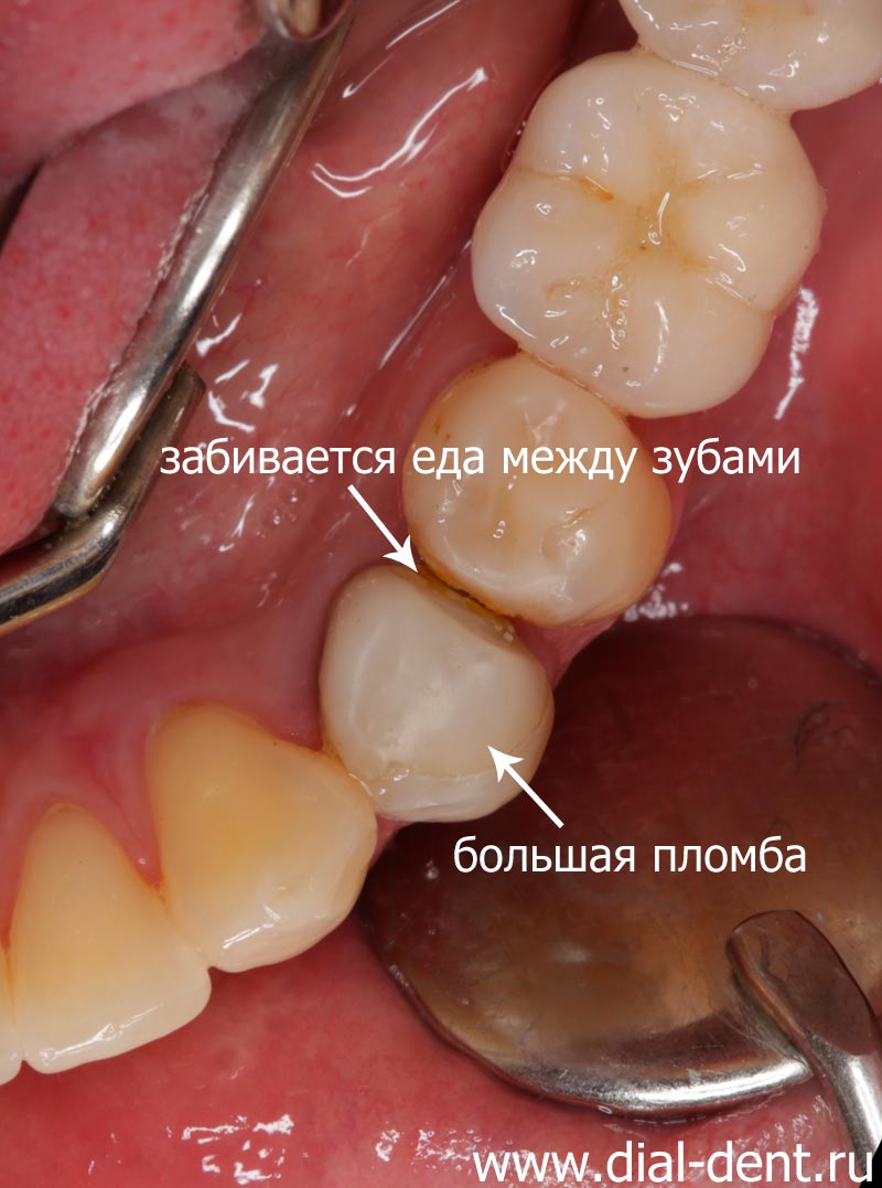 пломба очень большая, более половины зуба, нет контакта с соседним зубом