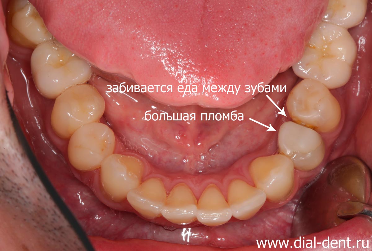 большая пломба в зубе не создает правильный контакт, щель между зубами