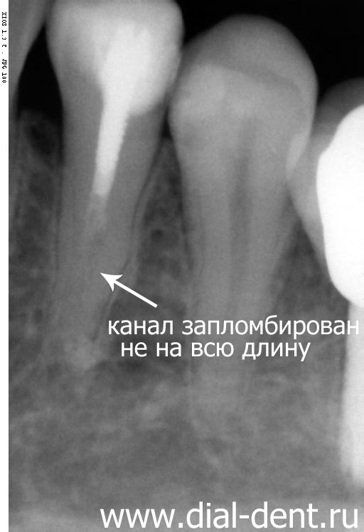 рентген зуба при обращении