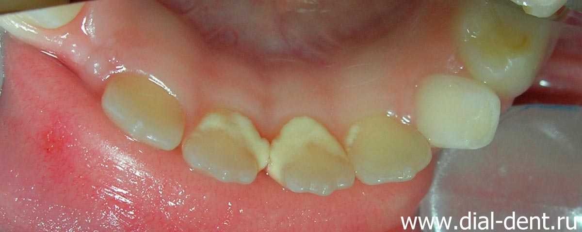 сильное скопление зубного налета на внутренних поверхностях зубов