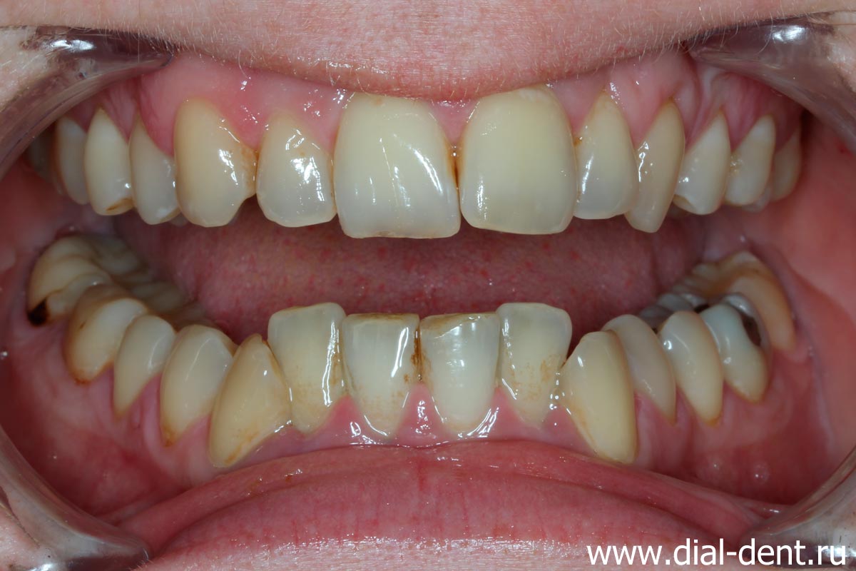 вид зубов до чистки у стоматолога