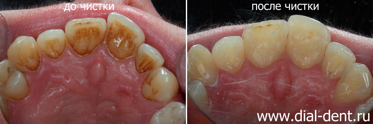 внутренняя поверхность верхних зубов до и после профессиональной чистки