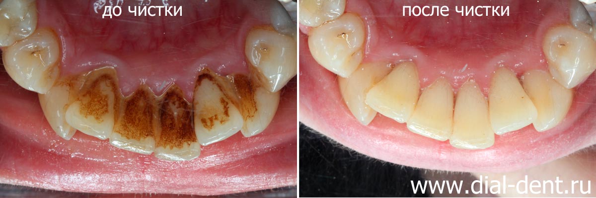 внутренняя поверхность нижних зубов до и после профессиональной чистки