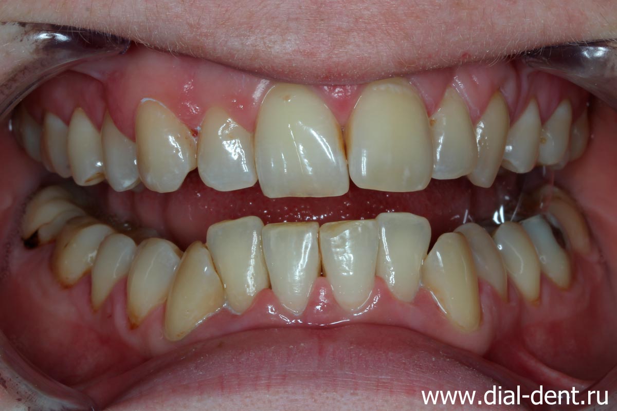 вид зубов после чистки у стоматолога