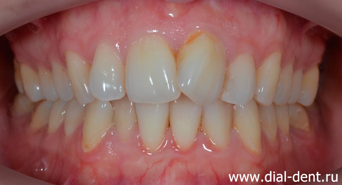 криво растут зубы, требуется ортодонтическое лечение