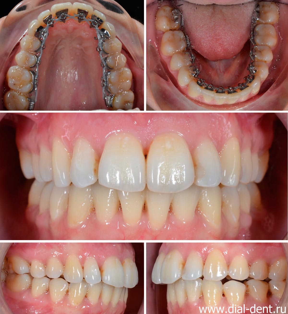 ортодонтическое лечение с использованием лингвальной брекет-системы WIN