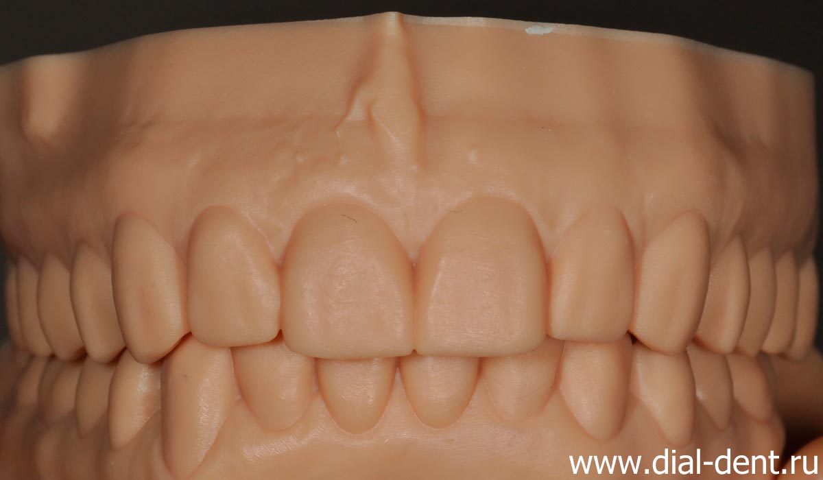 3D моделирование реставраций зубов