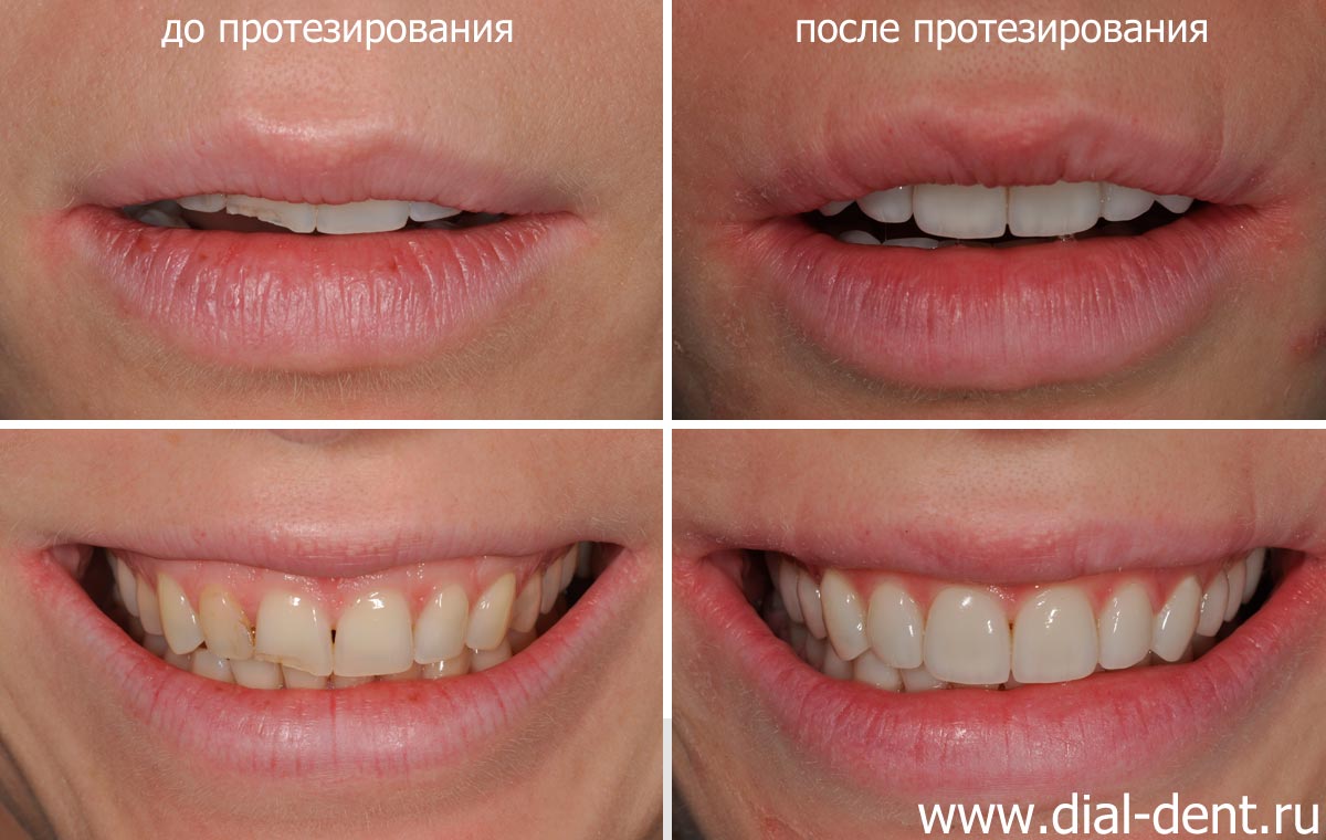 улыбка пациентки до и после протезирования зубов керамикой