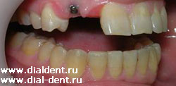 установлен имплант зуба