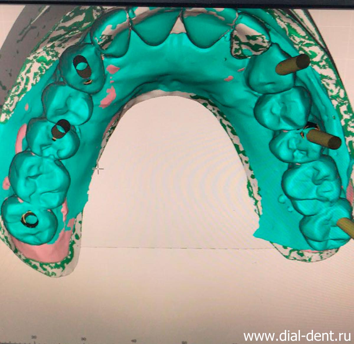 разработка хирургического шаблона для установки зубных имплантов