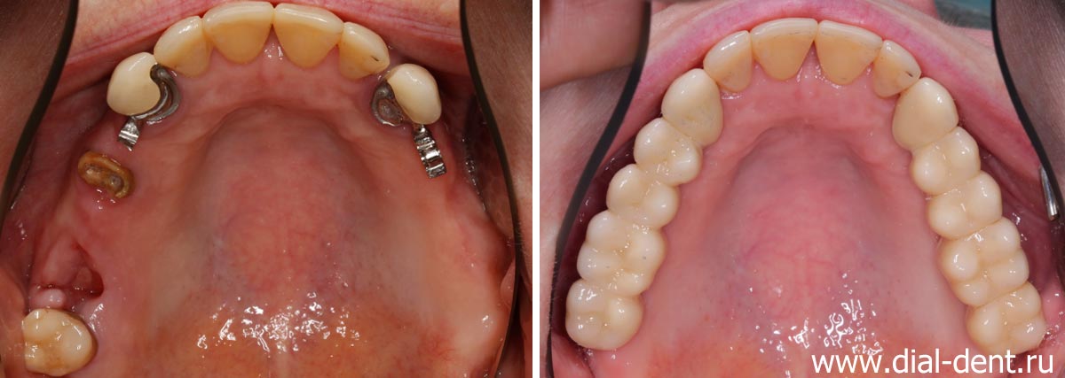 вид верхних зубов до и после протезирования на имплантах