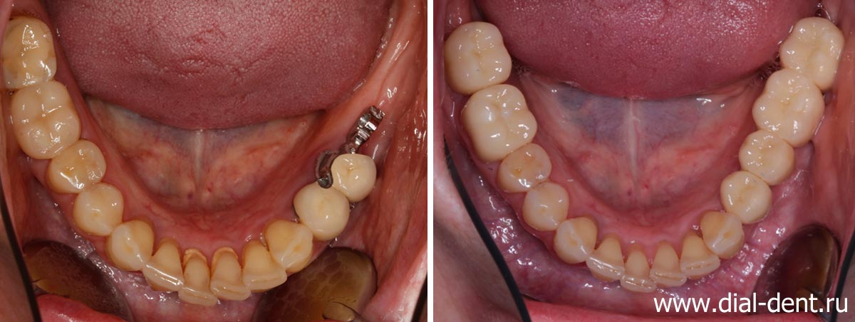 вид нижних зубов до и после протезирования на имплантах