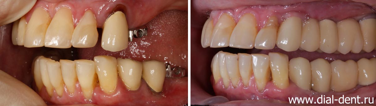 вид зубов слева до и после протезирования на имплантах