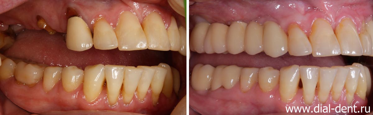 вид зубов справа до и после протезирования на имплантах