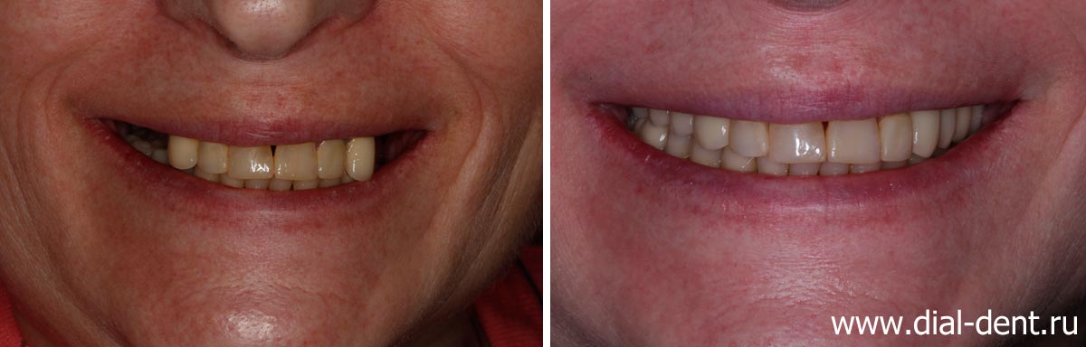улыбка до и после протезирования на имплантах