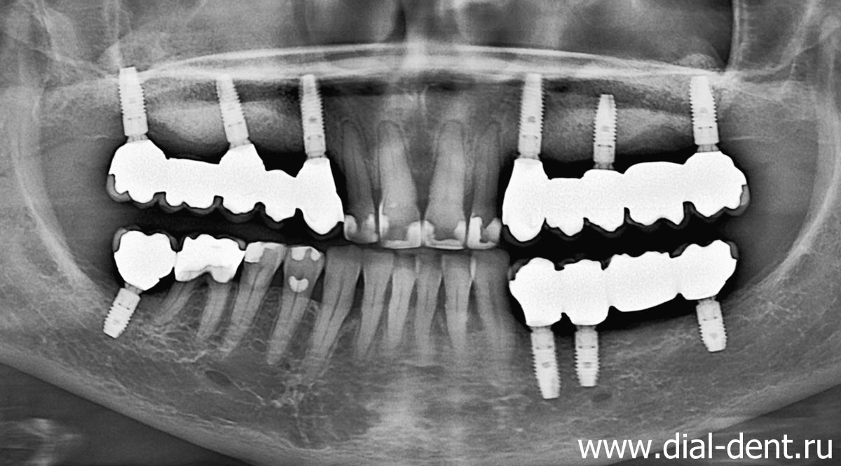 панорамный снимок зубов после протезирования