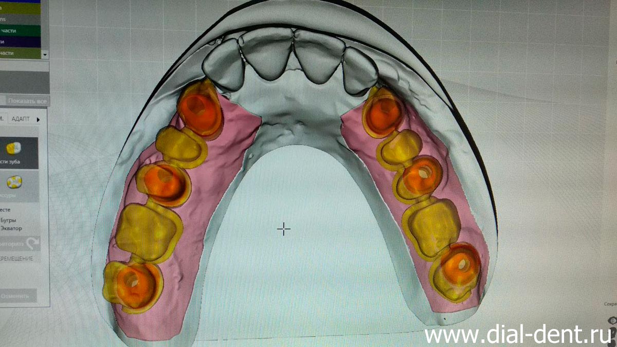планирование имплантации и протезирования зубов