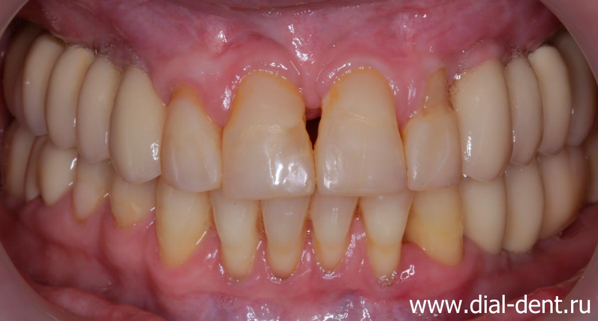 вид зубов после протезирования