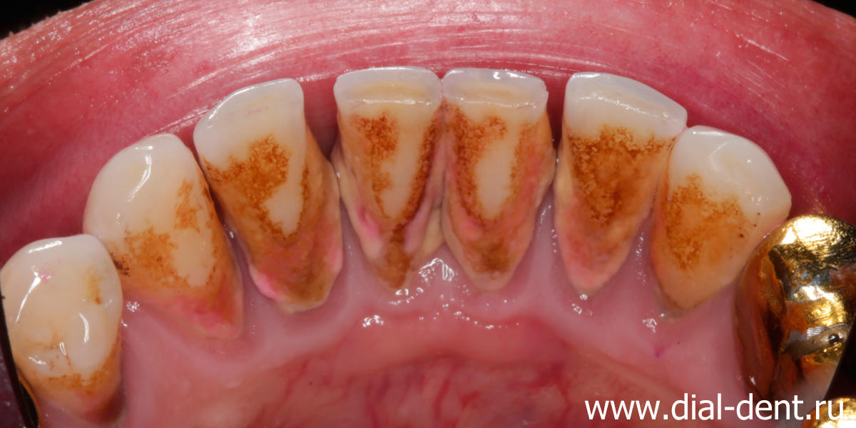 зубной камень на внутренней поверхности зубов