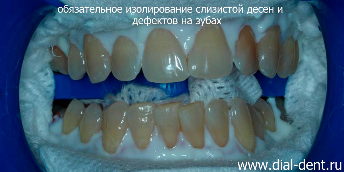 изоляция слизистой при отбеливании зубов