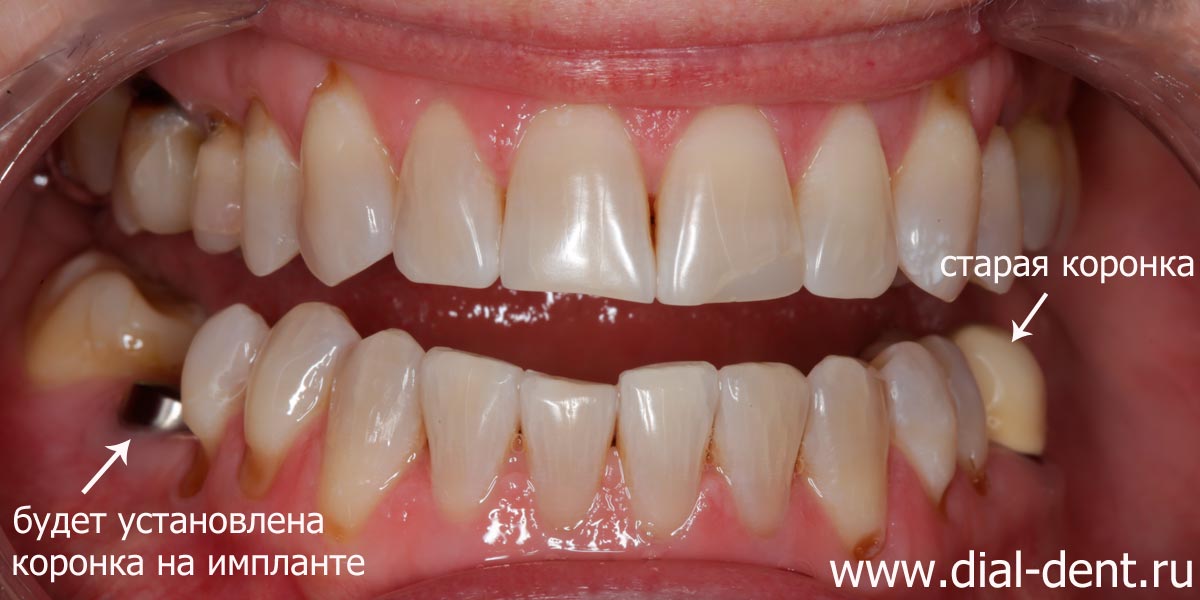 после отбеливания зубов можно ставить коронку нужного цвета и реставрировать дефекты