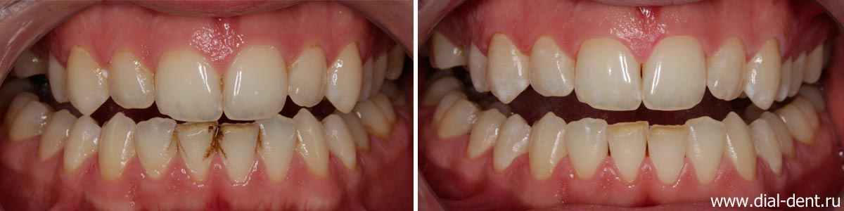 до и после чистки зубного налета курильщика