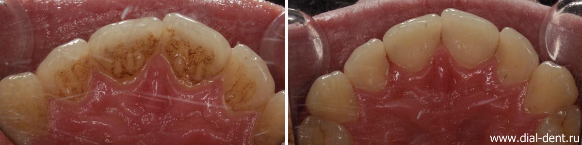 до и после чистки зубного налета курильщика - внутренняя поверхность верхних зубов