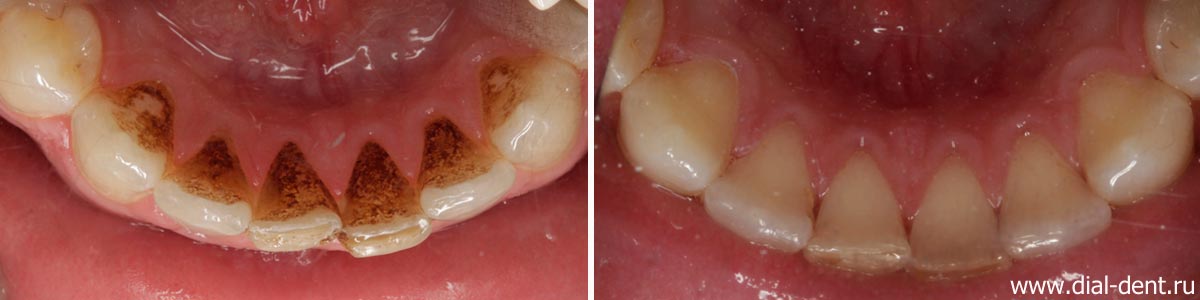 до и после чистки зубного налета курильщика - внутренняя поверхность нижних зубов