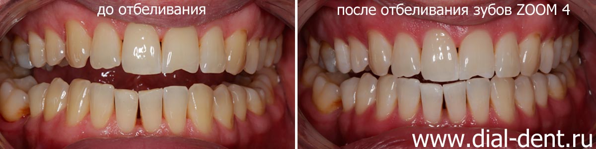цвет зубов до и после отбеливания ZOOM4