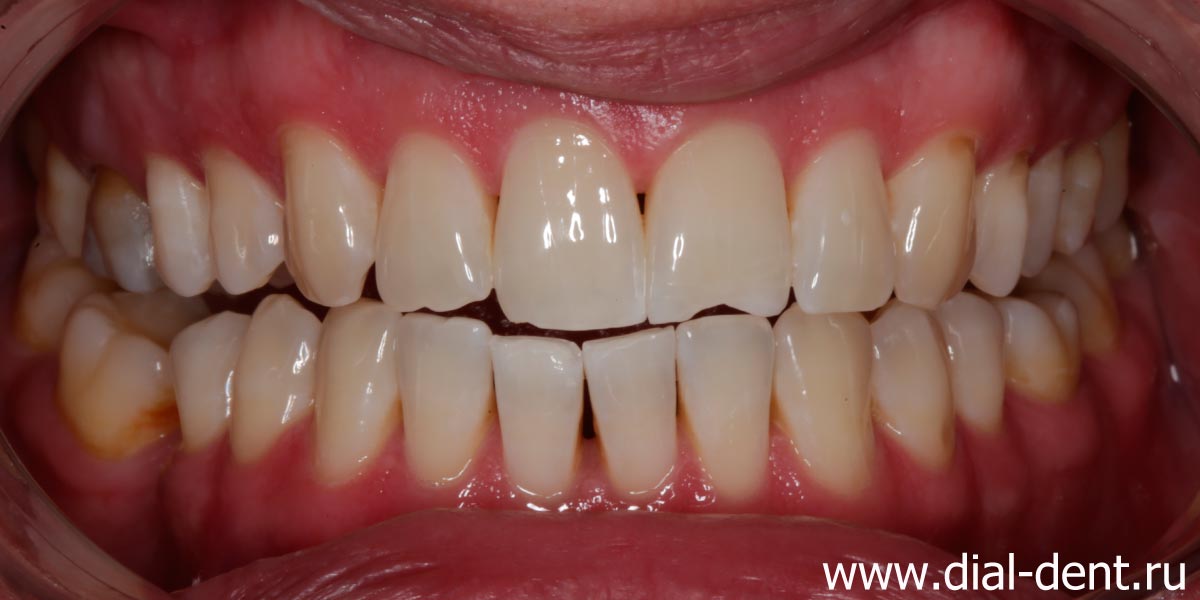 вид зубов после отбеливания ZOOM White Speed (ZOOM 4)