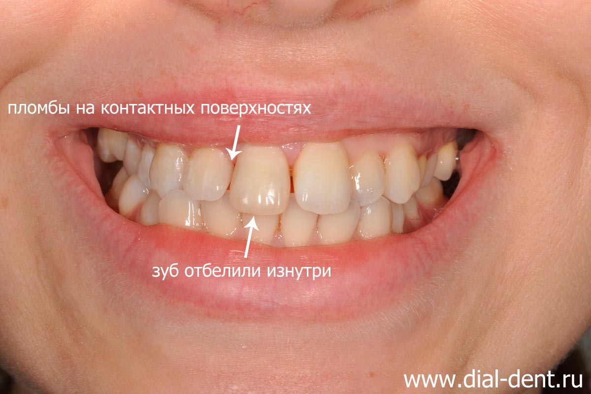 после лечения кариеса, лечения канала и отбеливания зуба