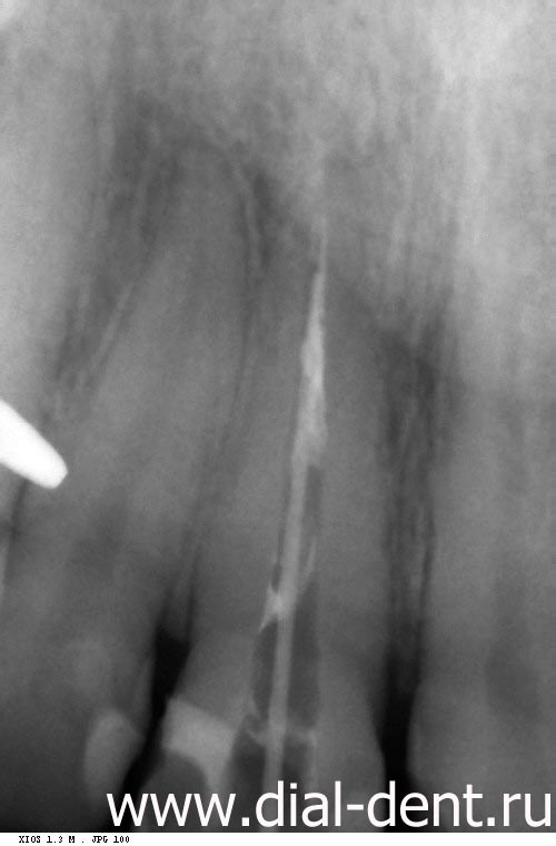 рентген зуба до лечения