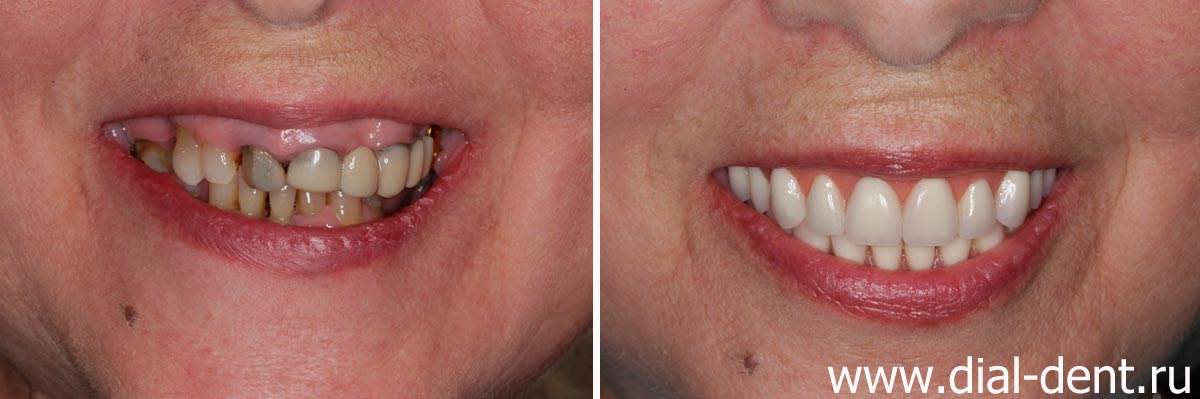 улыбка до и после протезирования зубов в Диал-Дент