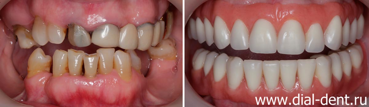до и после протезирования зубов телескопическими съемными протезами