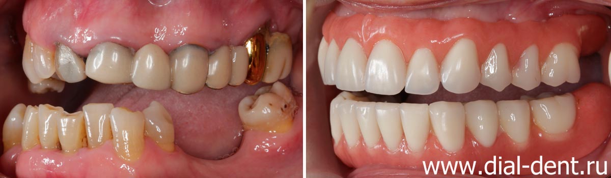 до и после протезирования зубов 