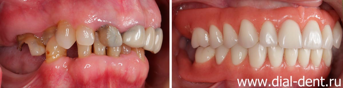 до и после протезирования зубов телескопическими зубными протезами