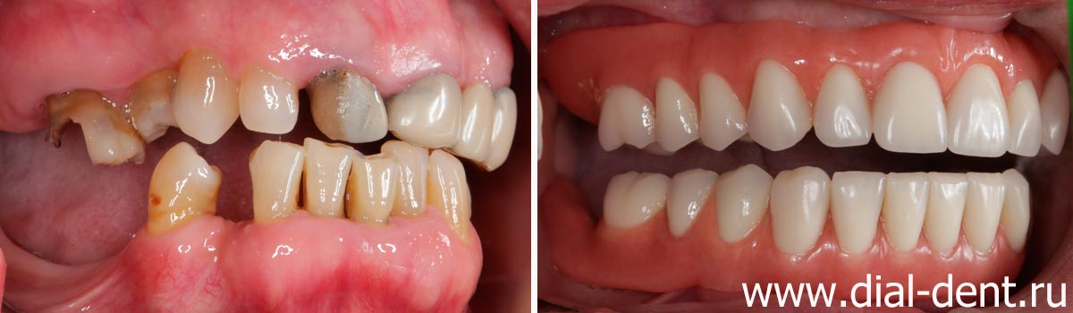 до и после протезирования зубов телескопическими зубными протезами