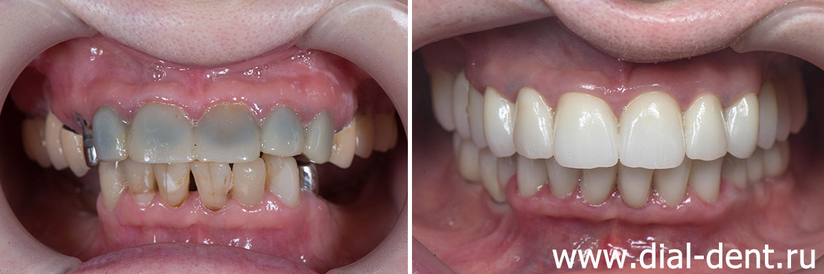 вид зубов до и после