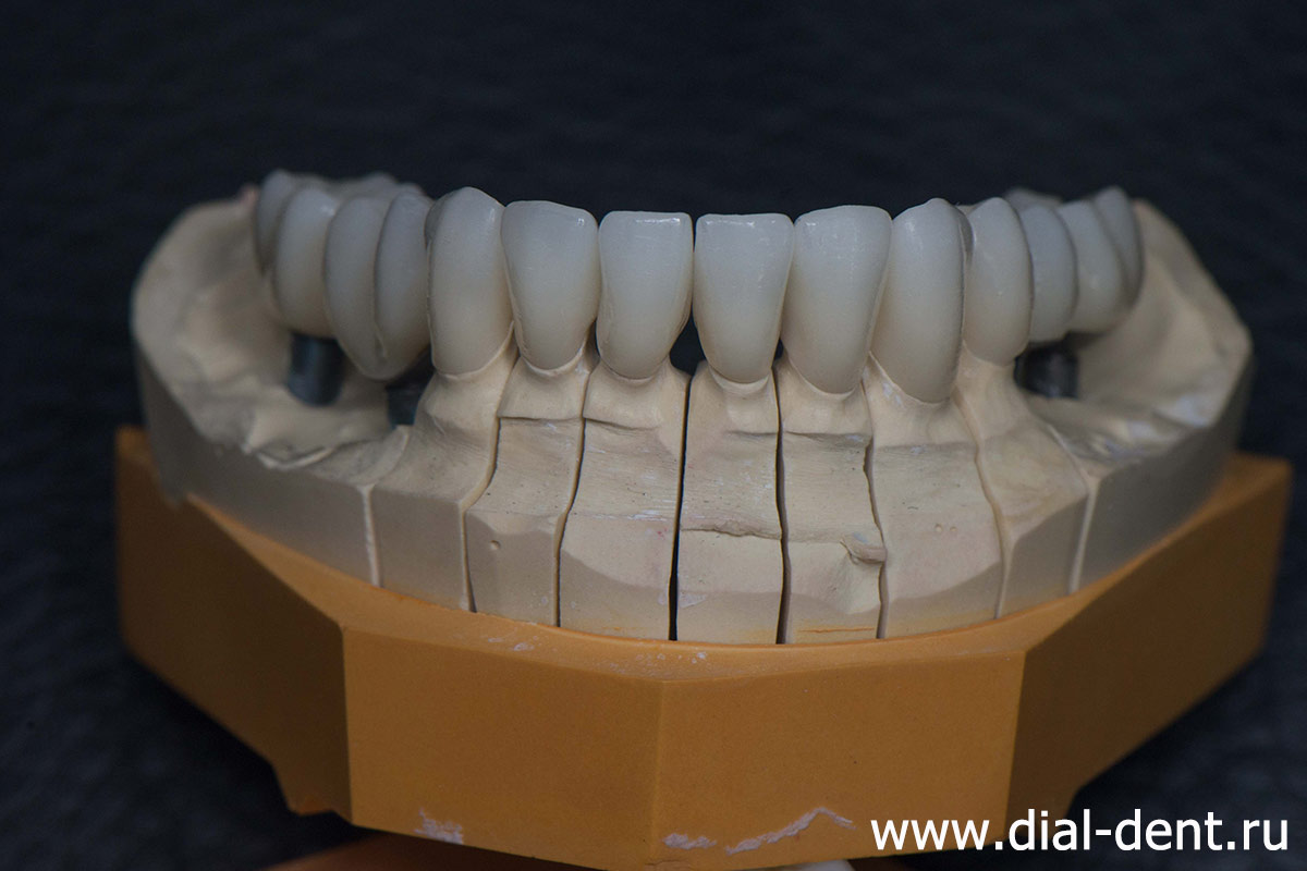 керамические зубные коронки на модели в лаборатории