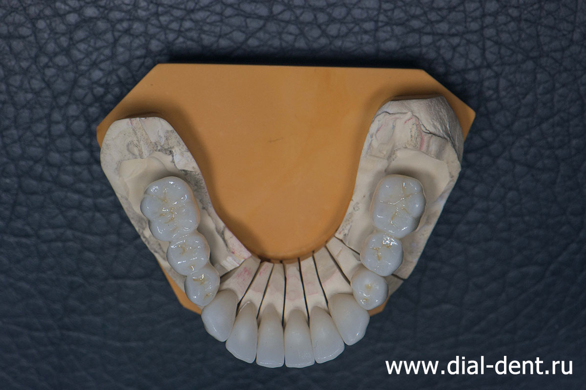 керамические зубные коронки на модели в лаборатории