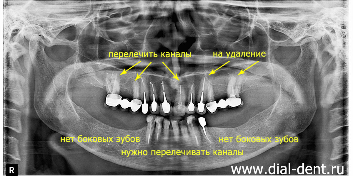 панорамный снимок зубов до лечения и протезирования