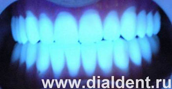 зубные протезы в диско-свете