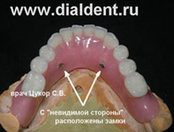 съемный зубной протез нижней челюсти